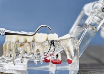 How a Root Canal Saves Your Natural Tooth