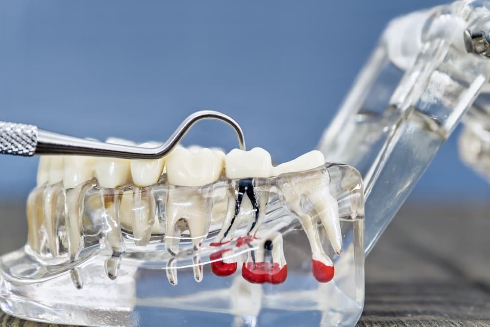 root canal procedure
