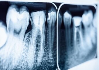 Signs You May Need a Root Canal