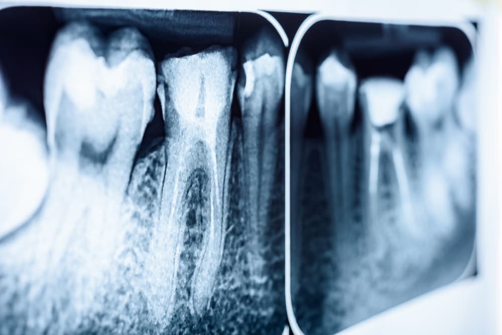 Root Canal