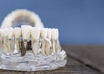 Smart Eating Choices After Getting Dental Implants