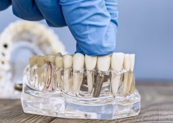 Restore Your Smile with Dental Implants in London