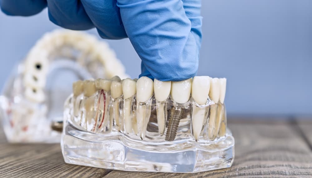 Dental Implants London